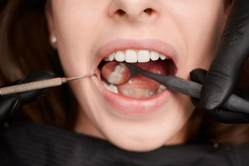 Cyst on the Gum